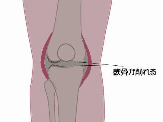 変形性膝関節症540
