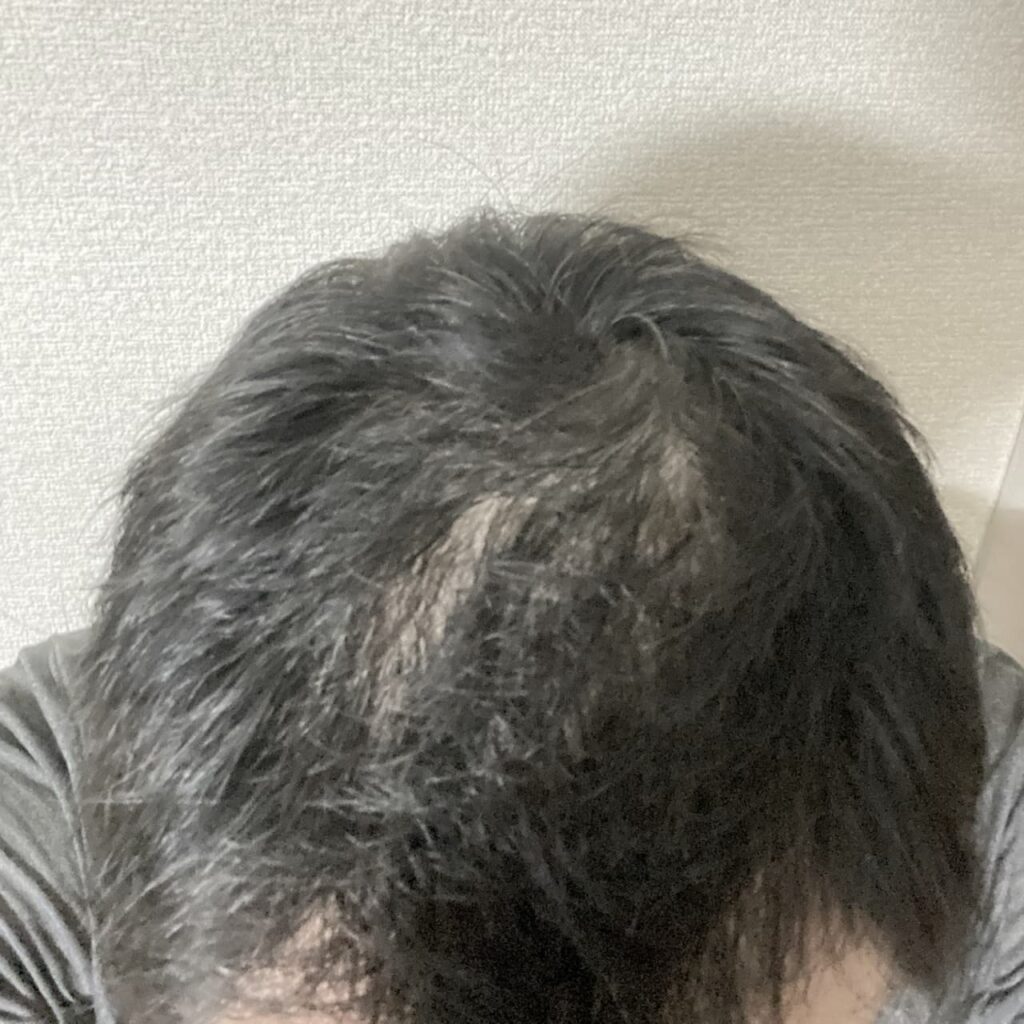 〝AGA治療0ヶ月〜〟頭頂部ハゲ写真