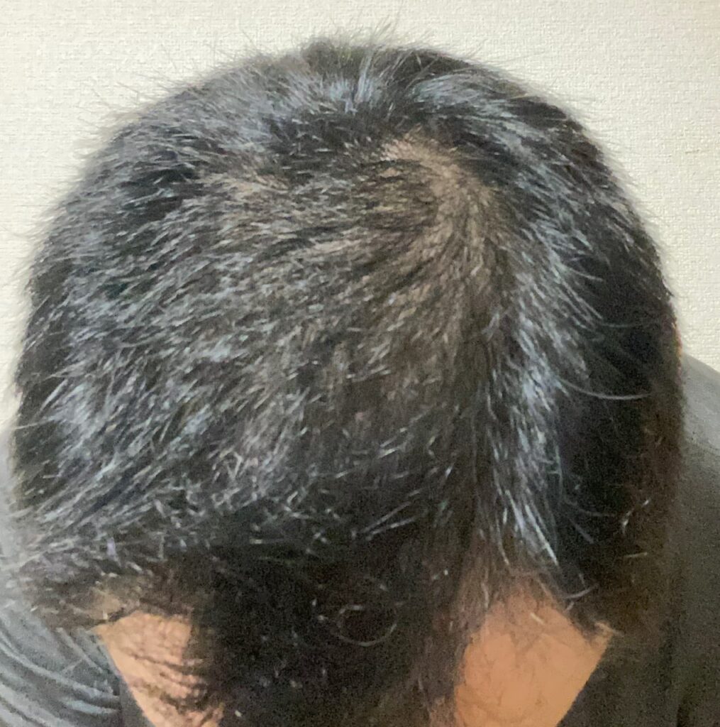 〝AGA治療薬 0ヶ月〜〟散髪後 頭頂部