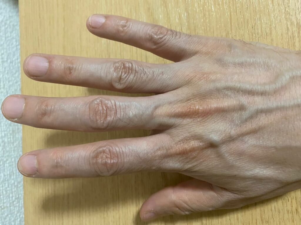 〝AGA治療薬 0ヶ月〜〟体毛(手の甲)写真