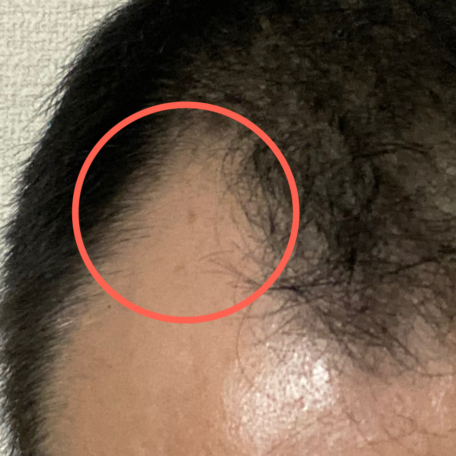 AGA治療1ヶ月＋7日目〝右剃り込み発毛〟拡大写真