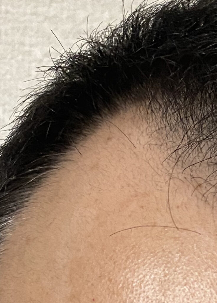 AGA治療1ヶ月15日目〝M字右ソリ発毛〟拡大写真
