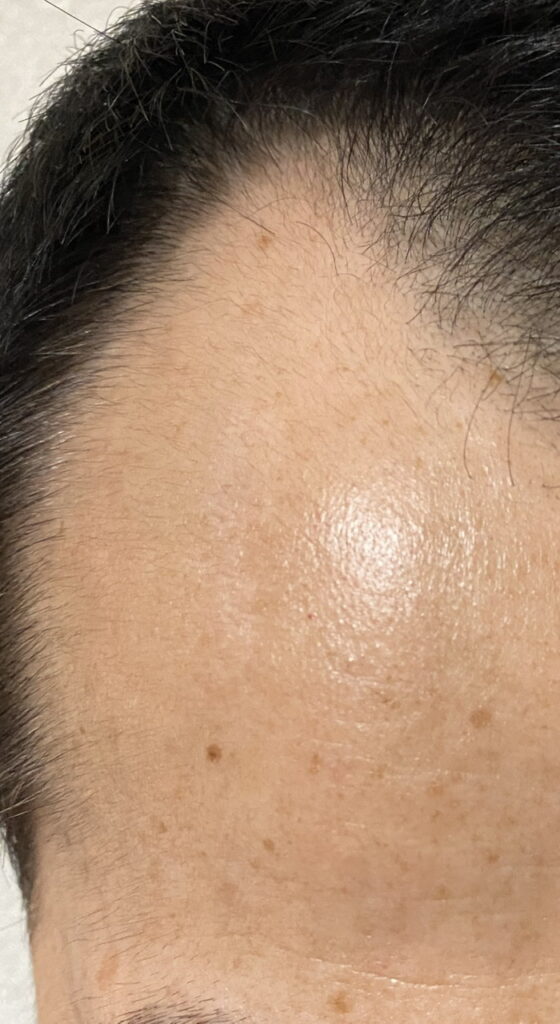 AGA治療58日目〝M字ハゲ広範囲に発毛〟拡大写真