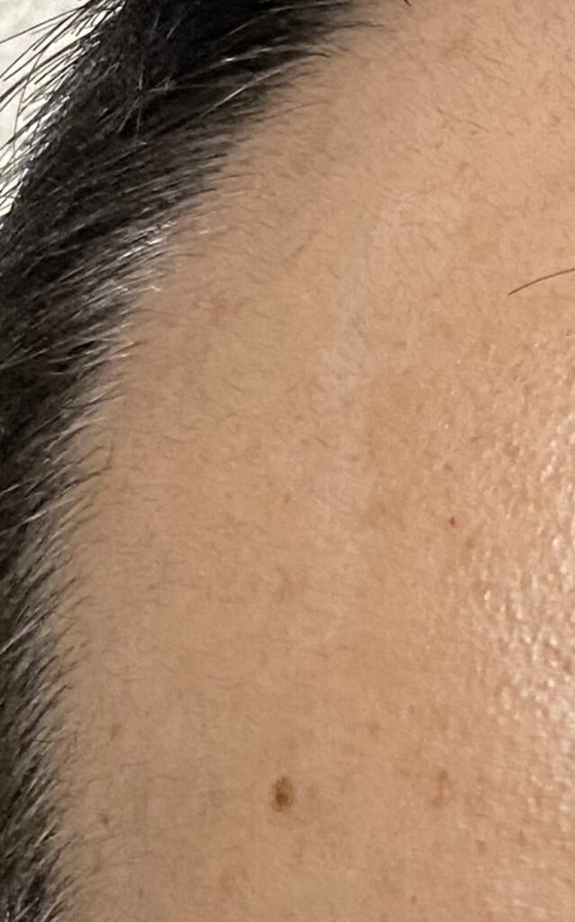 AGA治療1ヶ月15日目〝側頭部生え際の発毛〟拡大写真