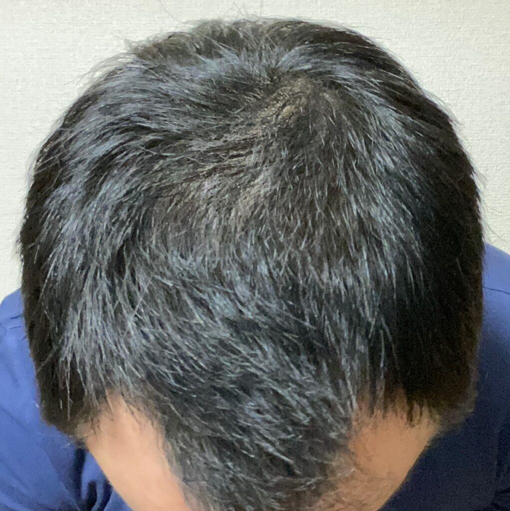 〝AGA治療薬 丸々2ヶ月〟頭頂部ハゲ写真