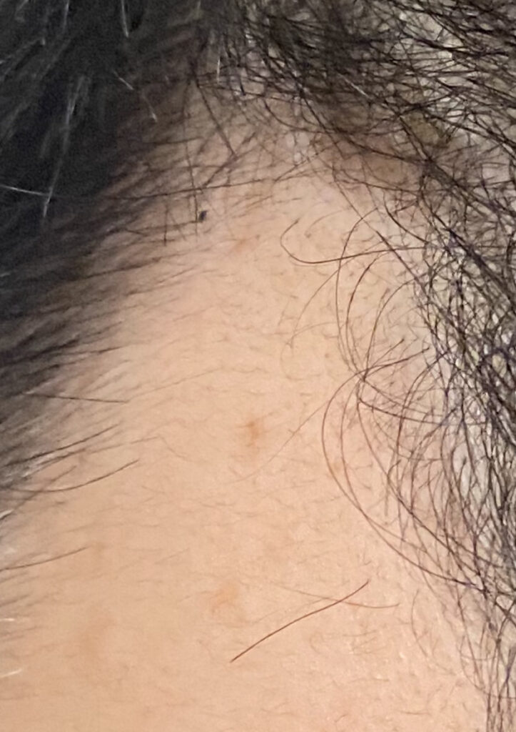 AGA治療1ヶ月13日目〝発毛を確認〟拡大写真