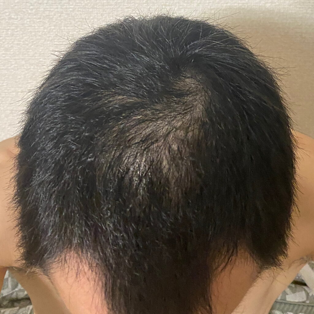 AGA治療53日目〝頭頂部薄毛〟写真