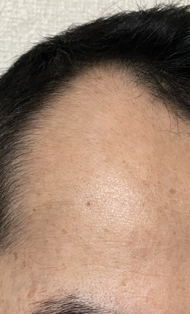 AGA治療2ヶ月26日目〝M字生え際発毛〟拡大画像