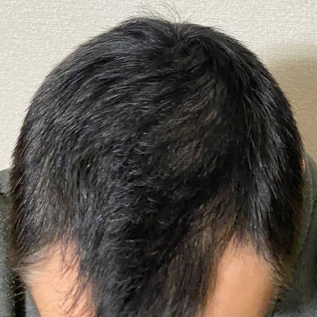 AGA治療2ヶ月20日目〝頭頂部発毛？〟拡大写真