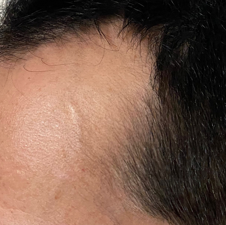 AGA治療3ヶ月16日目〝左側頭部生え際1.5センチ前進〟拡大写真