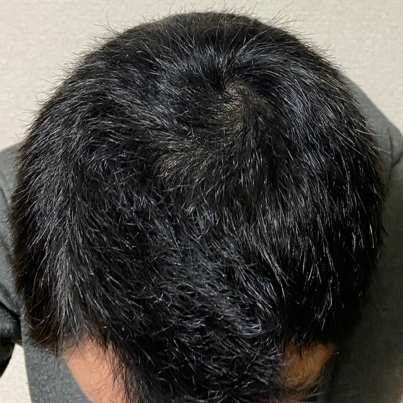 AGA治療丸3ヶ月経過〝頭頂部発毛〟証拠写真