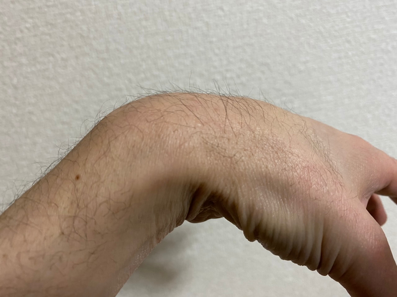 AGA治療3ヶ月30日〝親指の付け根〟多毛症写真2