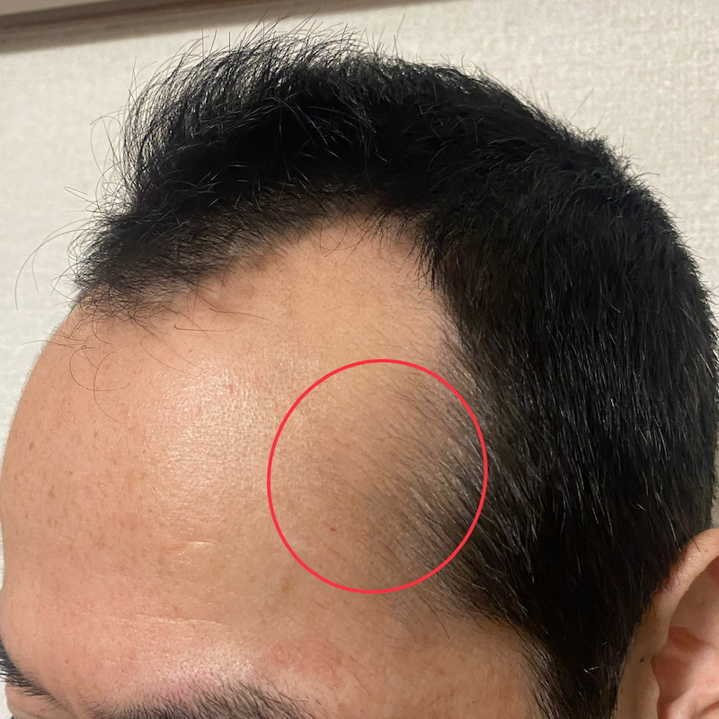 AGA治療3ヶ月2日〝側頭部生え際〟サイドライン発毛