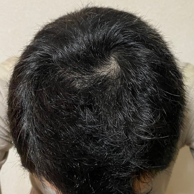ミノタブ＆フィナ丸4ヶ月経過〝頭頂部発毛〟証拠写真