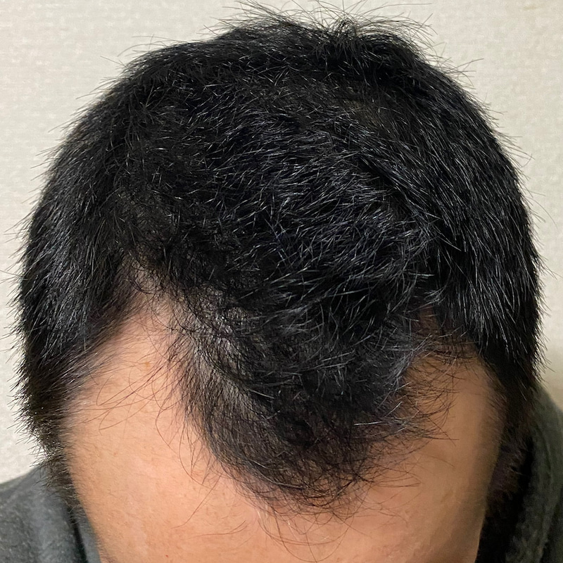 AGA治療丸3ヶ月経過〝M字中央生え際発毛〟証拠写真