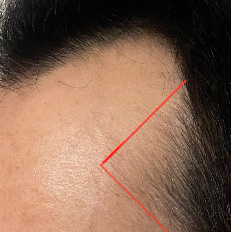 AGA治療3ヶ月25日目〝側頭部生え際発毛〟拡大写真