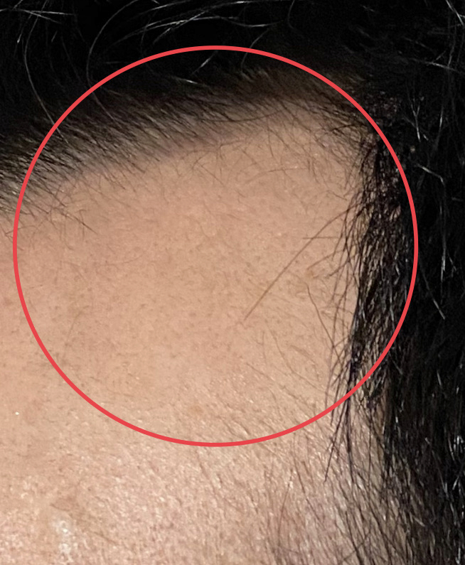 AGA治療4ヶ月27日目〝おでこ産毛が凄い〟拡大画像