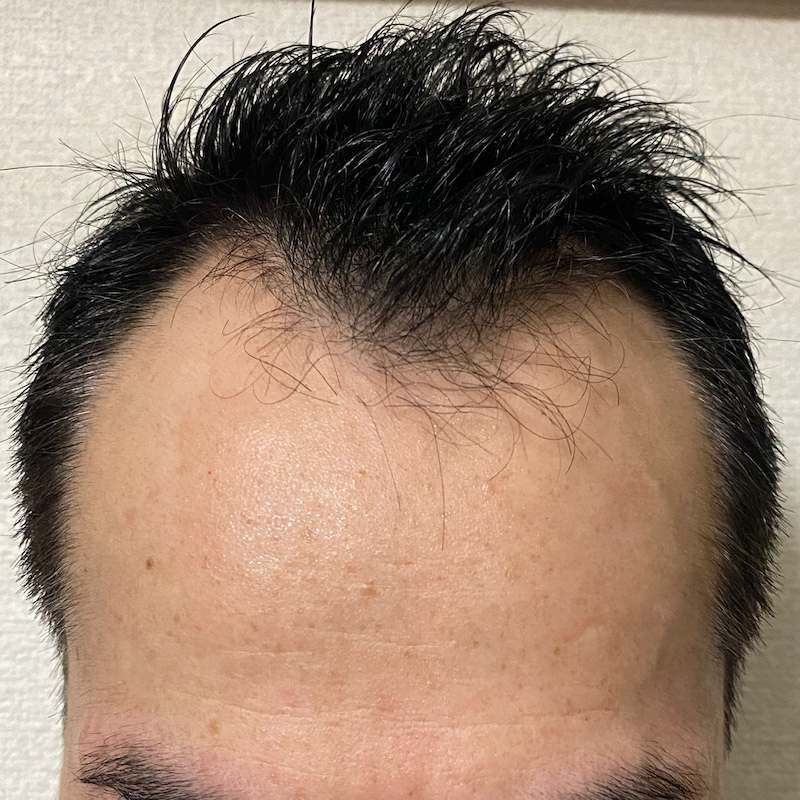 AGA治療5ヶ月15日経過〝ハゲ髪濡れた状態〟画像