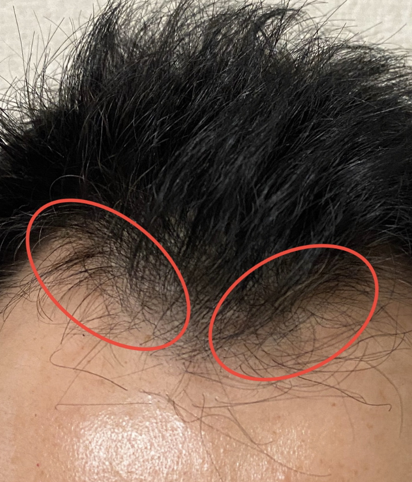 AGA治療5ヶ月20日経過〝M字生え際発毛〟拡大画像