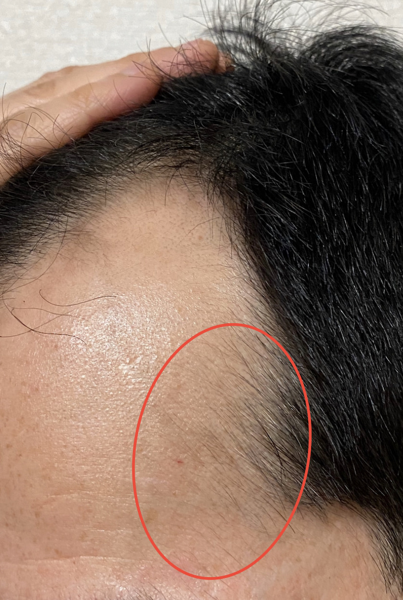 AGA治療丸6ヶ月(半年)〝左側頭部生え際〟拡大画像