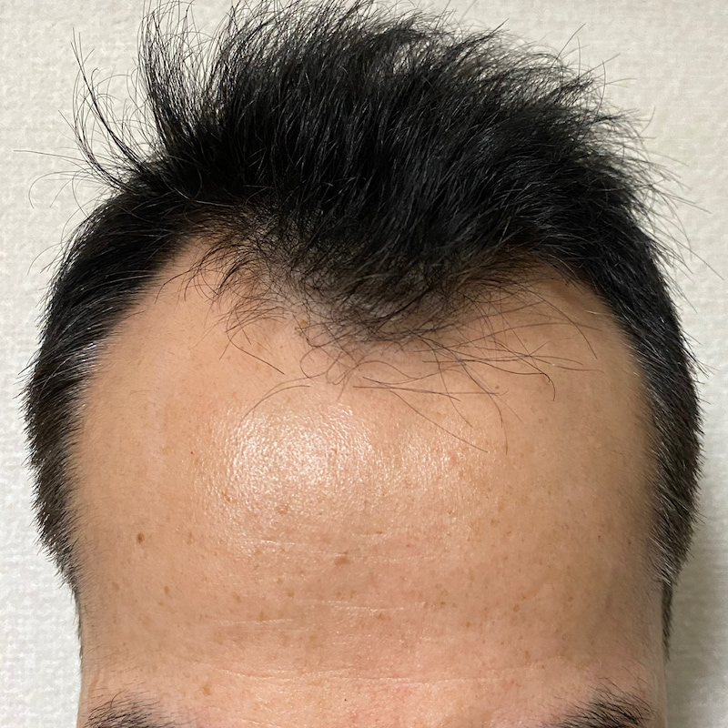 AGA治療5ヶ月9日経過〝M字生え際〟発毛画像