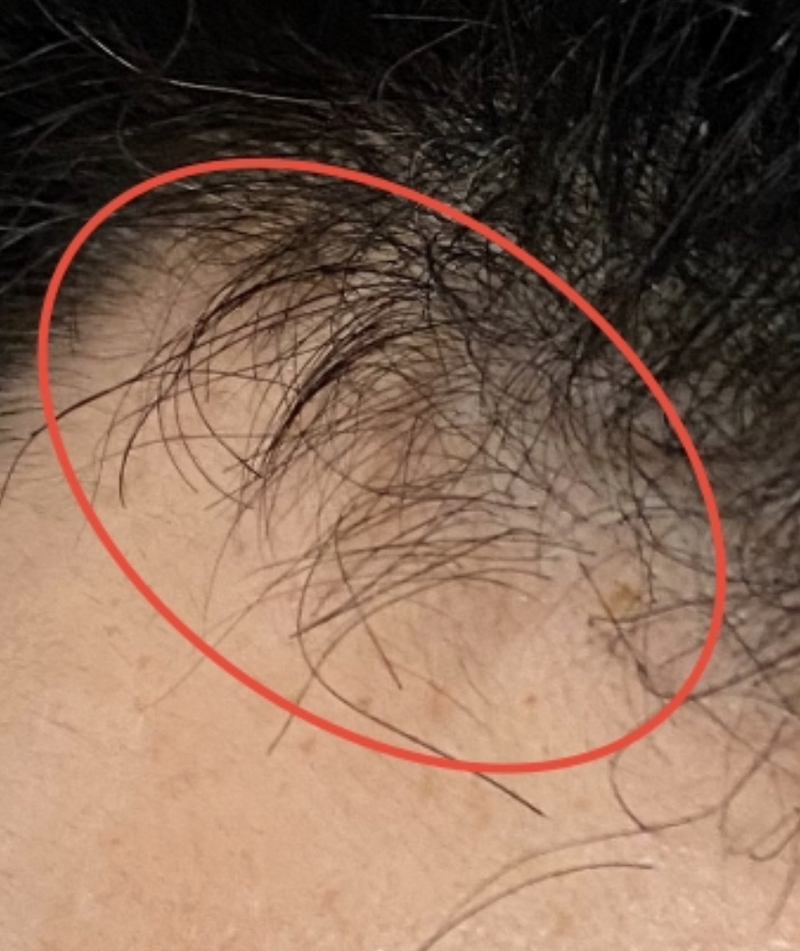 AGA治療5ヶ月9日経過〝M字生え際 発毛〟拡大画像②