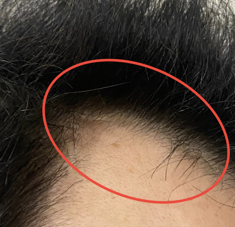 AGA治療5ヶ月19日経過〝M字右ソリ発毛〟拡大証拠画像
