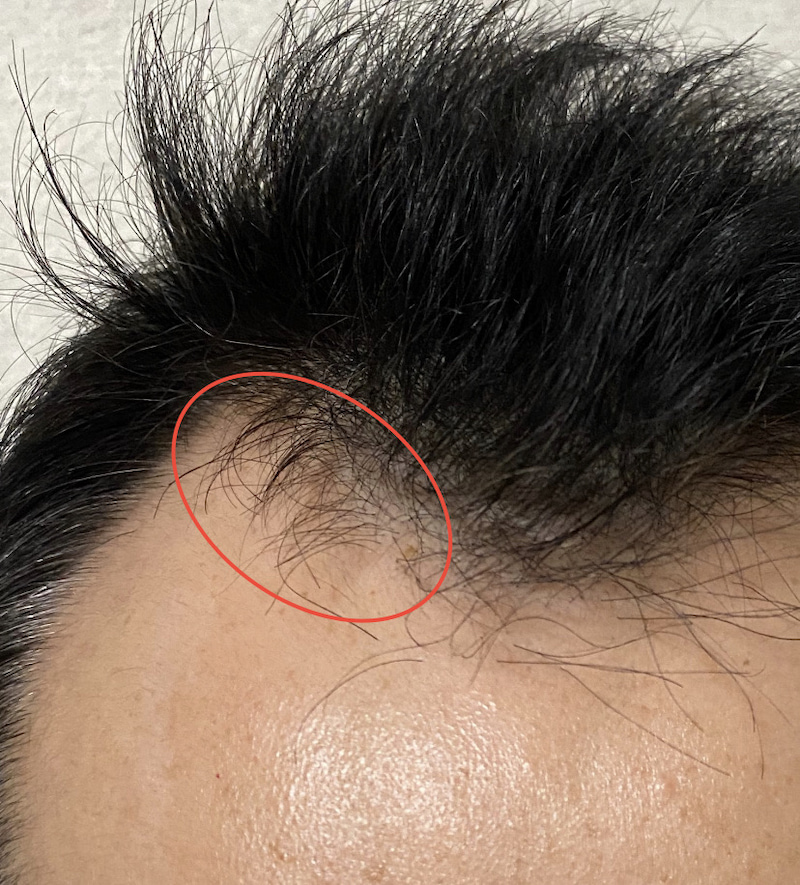 AGA治療5ヶ月9日経過〝M字生え際 発毛〟拡大画像