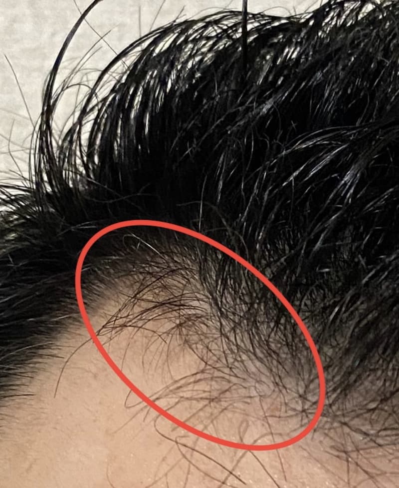 AGA治療5ヶ月15日経過〝ハゲ髪濡れた状態〟拡大画像
