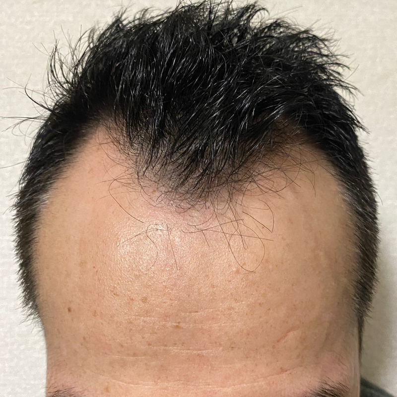 AGA治療6ヶ月7日経過〝M字生え際 髪濡れた〟画像