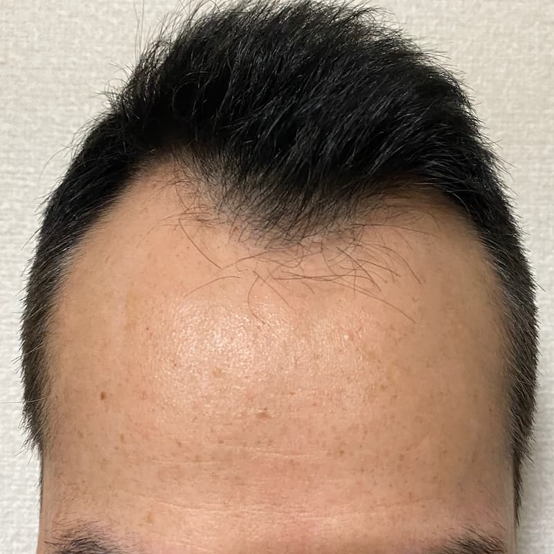 AGA治療6ヶ月(半年)3日経過〝M字生え際〟散髪後画像