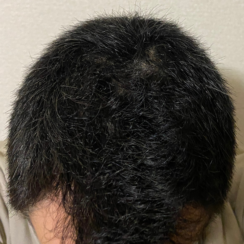 AGA治療丸7ヶ月〝頭頂部〟効果画像