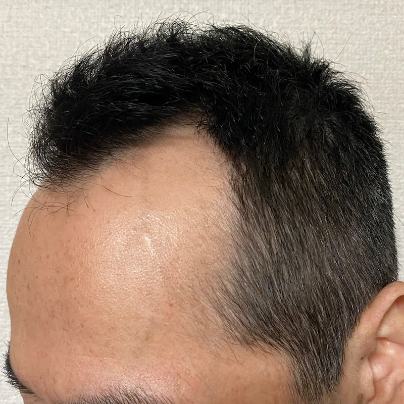 AGA治療6ヶ月(半年)3日経過〝M字左ソリ〟散髪後画像