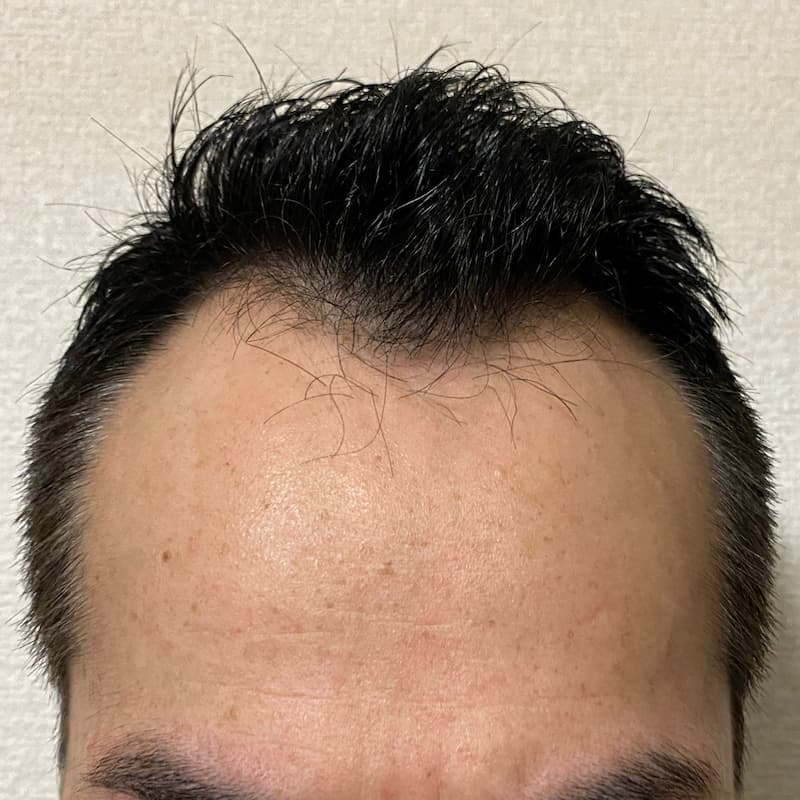 AGA治療6ヶ月17日経過〝M字生え際中央〟髪濡れ画像