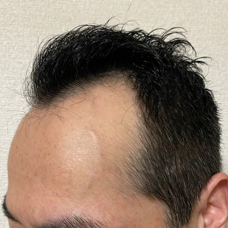 AGA治療6ヶ月17日経過〝M字生え際左ソリ〟髪濡れ画像