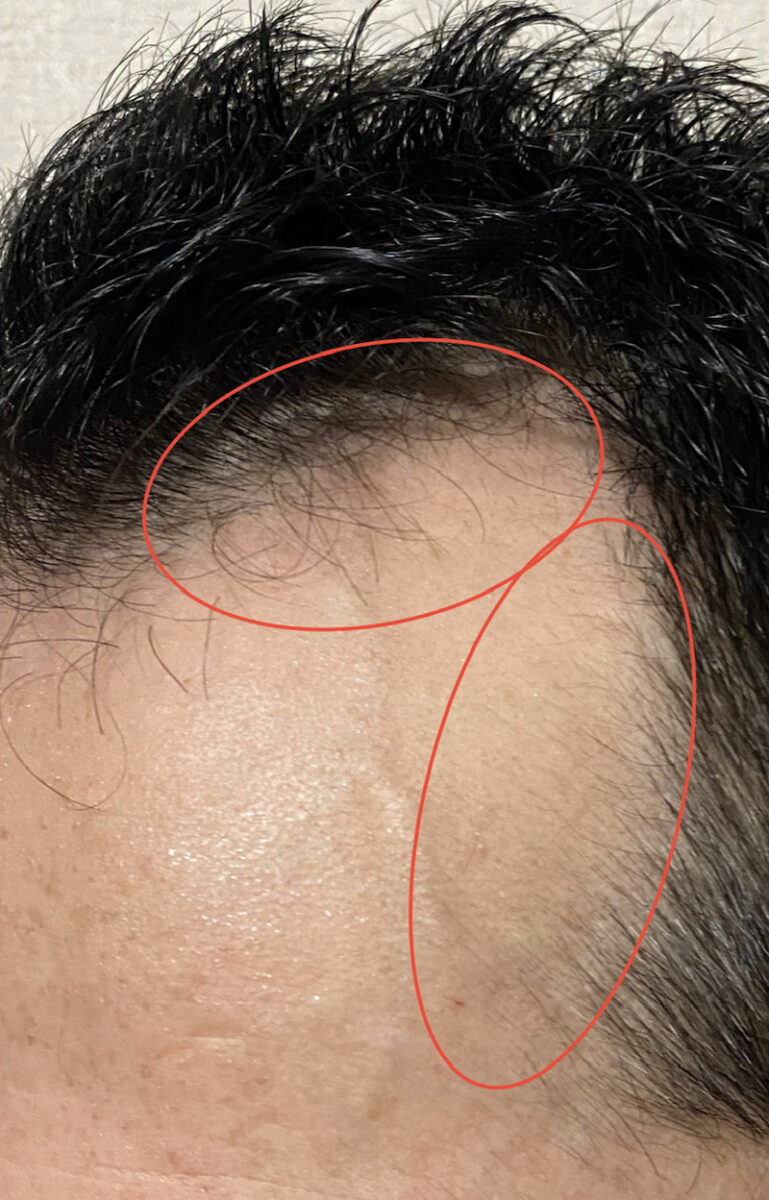 AGA治療6ヶ月7日経過〝髪濡れた(発毛証拠)〟拡大画像