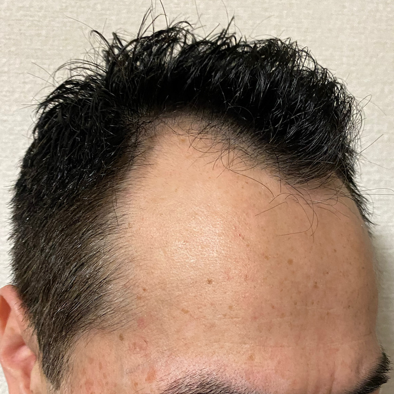 AGA治療6ヶ月17日経過〝M字生え際右ソリ〟髪濡れ画像
