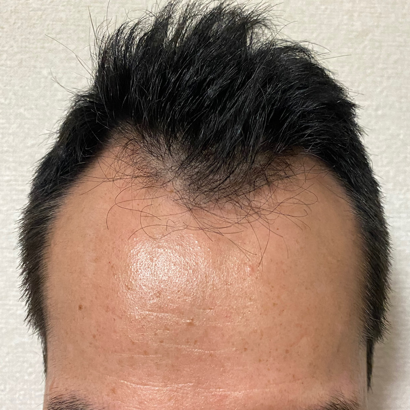 AGA治療丸8ヶ月経過〝M字中央の発毛効果〟画像