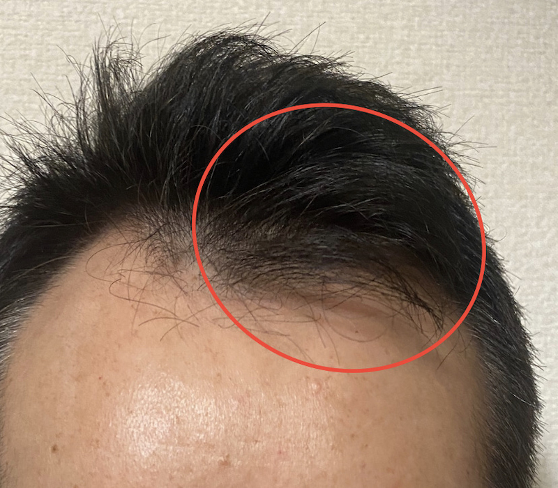 AGA治療7ヶ月17日経過〝前髪生えてきた？〟拡大写真