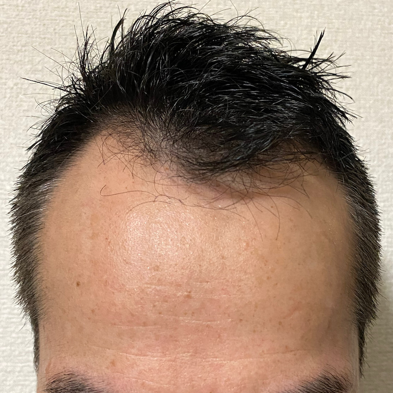 AGA治療7ヶ月27日経過〝風呂上がり前髪スカスカ〟比較画像