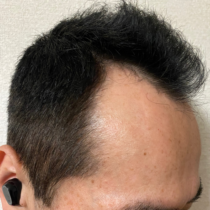 AGA治療丸8ヶ月経過〝M字右ソリの発毛効果〟画像