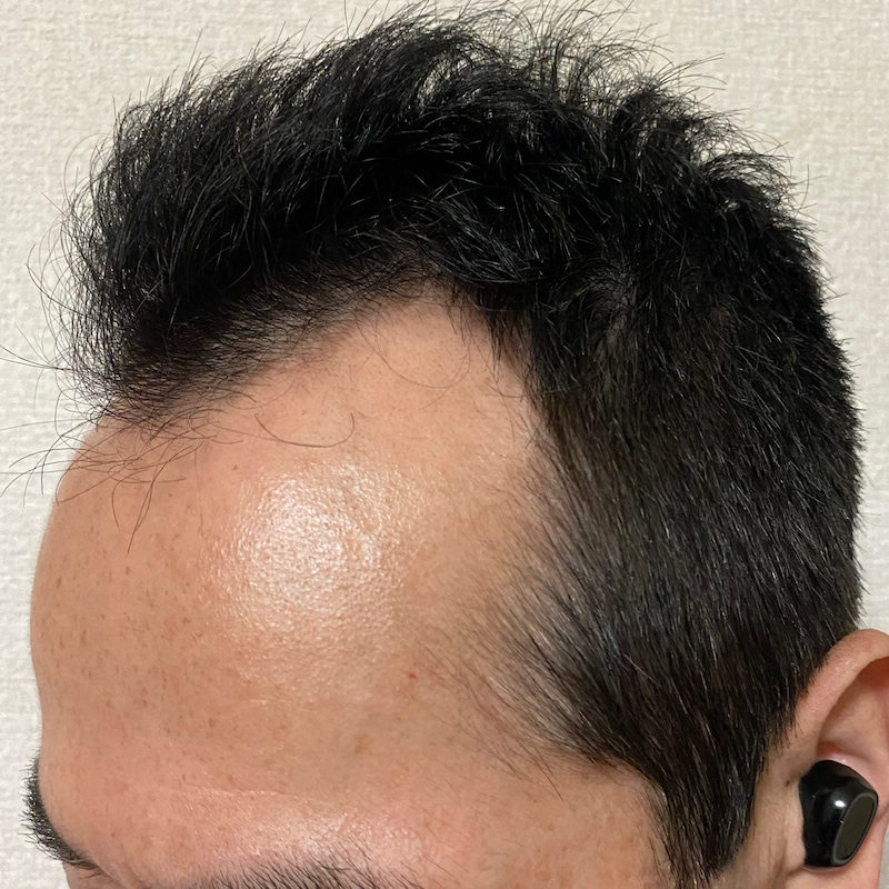 AGA治療丸8ヶ月経過〝M字左ソリの発毛効果〟画像