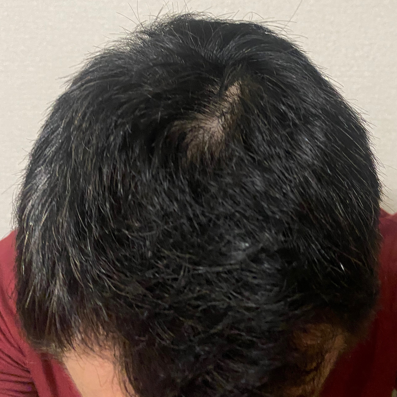 AGA治療9ヶ月経過報告〝頭頂部〟画像