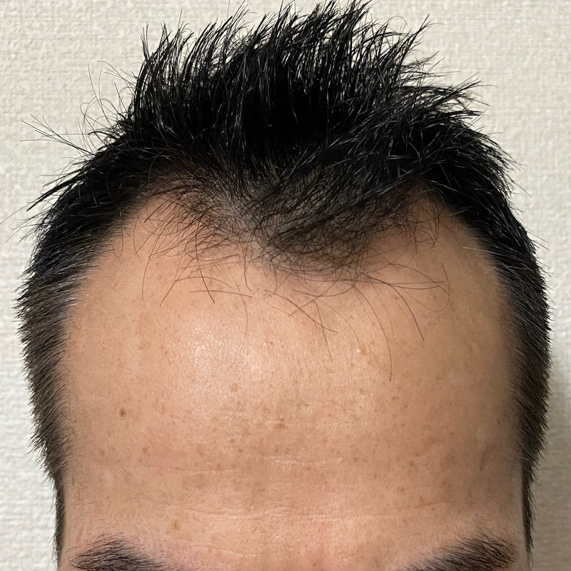 AGA治療9ヶ月25日 経過〝濡れ髪〟写真