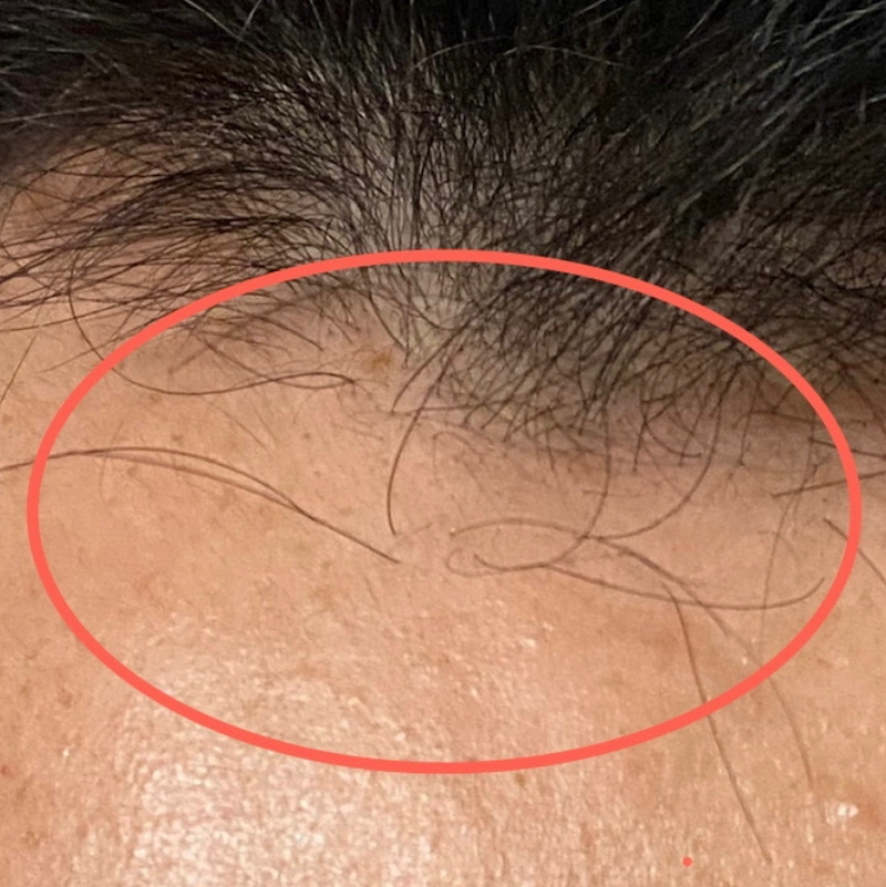 AGA治療11ヶ月3日経過〝M字中央新たな発毛〟拡大画像