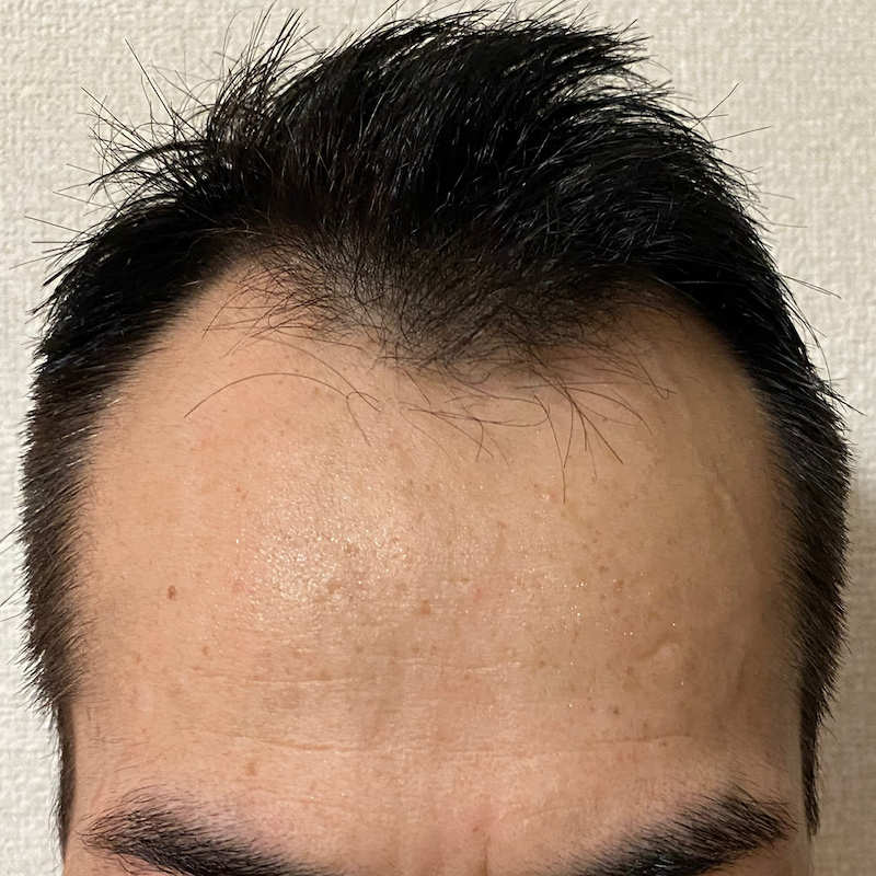 AGA治療10ヶ月29日経過〝M字生え際中央〟濡れ髪画像