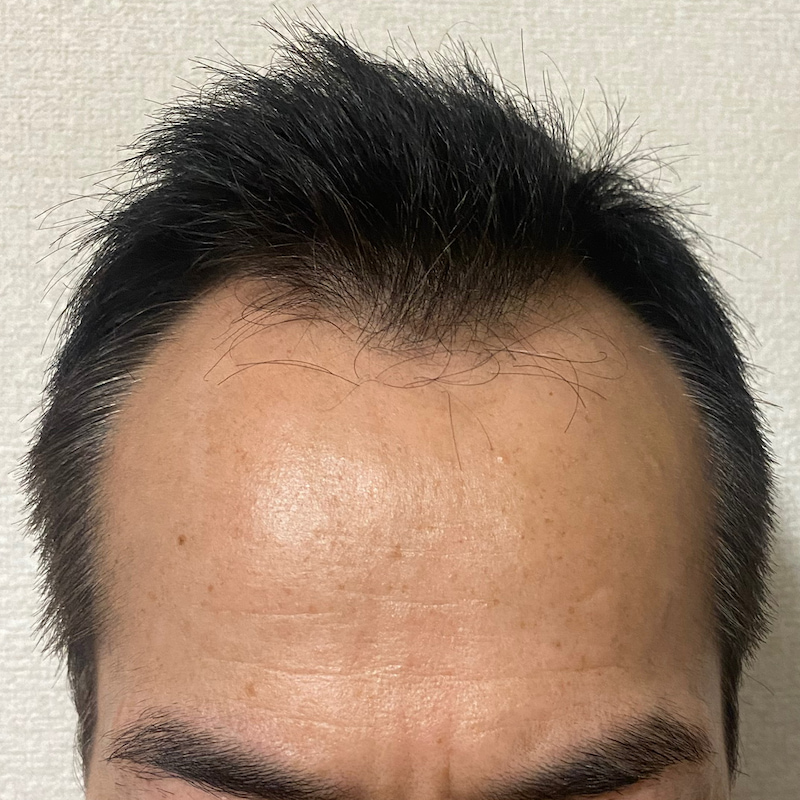 AGA治療10ヶ月12日〝髪を左から流す〟に変更