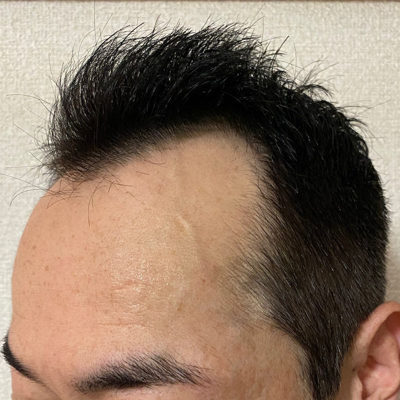 AGA治療10ヶ月29日経過〝M字生え際左ソリ〟濡れ髪画像