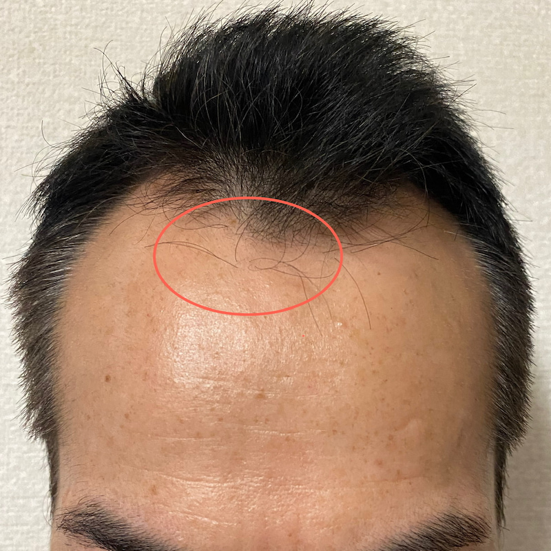 AGA治療11ヶ月3日経過〝M字中央新たな発毛〟画像