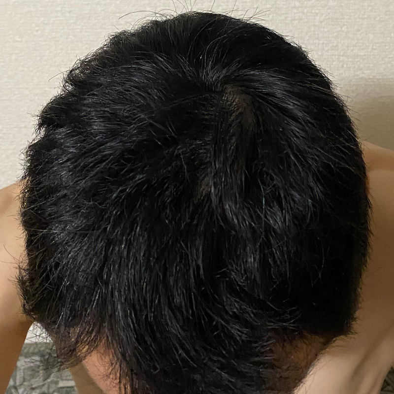 AGA治療10ヶ月25日経過〝頭頂部〟写真